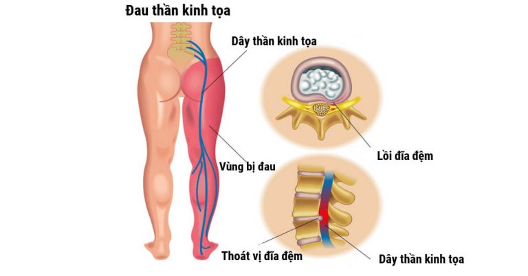 Đau thần kinh tọa là gì ? Các Nguyên nhân gây ra bệnh Đau thần kinh tọa